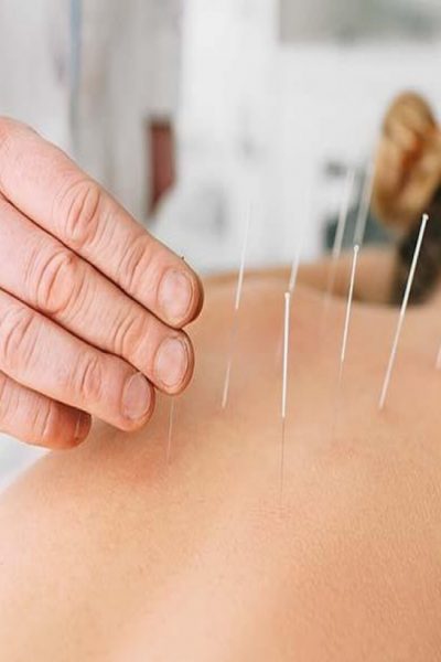 acupuncture acupuncture